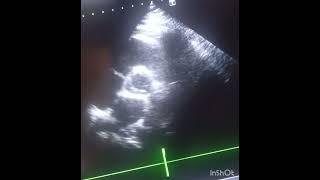 Bicuspid aortic valve a congenital anomaly [upl. by Crim]