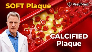 The Difference between Soft plaque and Calcified plaque [upl. by Rayner]