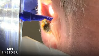 Water Device Painlessly Removes Earwax  Art Insider [upl. by Asikal491]