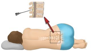 Punkcja lędźwiowa nakłucie lędźwiowe [upl. by Falconer]
