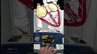 Atrial Fibrillation Cardioversion Video and Animation 🫀🔌 medical cardiology [upl. by Alexandr]