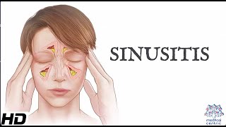 Sinusitis Everything You Need To Know [upl. by Ennaihs245]