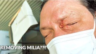 She Paid a Professional to Remove Her Eye Milia and This Happened [upl. by Tahp410]