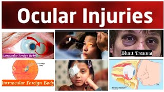 Ocular Injury 4 Major Intraocular Foreign BodiesSiderosis BulbiChalcosis and Penetrating Injury [upl. by Nylhtac]