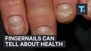 Fingernails can tell about health [upl. by Tut]