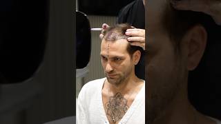 Cosmedica Clinic Hair Transplant in Turkey shorts hairtransplant video [upl. by Perlman]