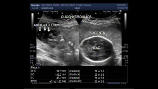 Oligohydramnios with loss of fetal movements and Pregnancy of about 23 weeks [upl. by Seleta484]