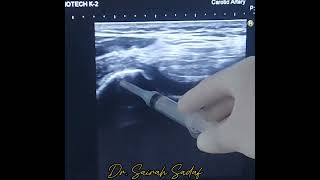 intraarticular Knee injection for OA knee joint by Dr Sairah Sadaf [upl. by Olihs700]