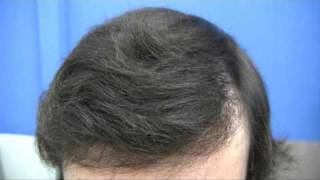 DrWong 6121 grafts in 2 sessions [upl. by Paulette837]