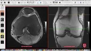 Systematic Interpretation of Knee MRI How I do it [upl. by Dinesh]