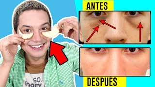 COMO QUITAR LAS OJERAS OSCURAS Y BOLSAS DE OJOS RÁPIDO CON REMEDIOS CASEROS  AndyZaturno [upl. by Jephthah]