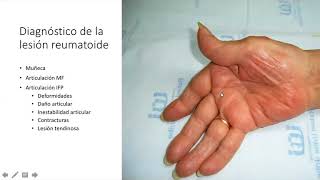 Webinar Manejo Médico Quirúrgico y Terapéutico de la Artritis Reumatoidea en Mano y Muñeca [upl. by Camilo]