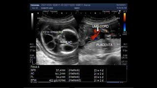 Multiple Fetal Anomalies with Pregnancy of about 21 weeks [upl. by Ardnas]