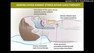 Hypoglossal nerve stimulation for obstructive sleep apnea [upl. by Culley72]