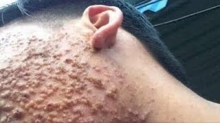 Big Cystic Acne Blackheads Extraction Blackheads amp Milia Whiteheads Removal Pimple Popping [upl. by Garland]