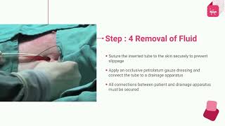 Thoracostomy Tube Chest Drain Insertion Technique [upl. by Ahsart367]