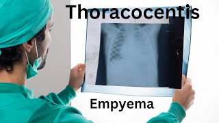 lung empyema empyema lungs effusion puslungdiseases respiratorydiseases thoracocentisis [upl. by Elden107]