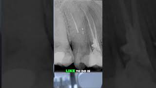 Root Canal Secrets How I Approach File Removal [upl. by Norvan]