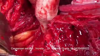 CESAREAN SECTION IN PLACENTA INCRETA UTERUS CONSERVE [upl. by Derna]