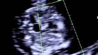 Fetal heart scan at 11 weeks of pregnancy [upl. by Lemar395]