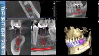 Implant Planning in Planmeca Romexis [upl. by Dualc]