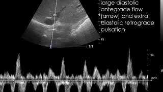 CASE 711 Congestive hepatopathy Chronic passive congestion [upl. by Nerfe]