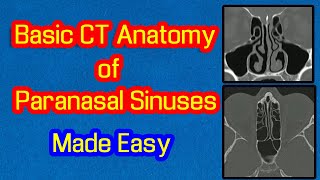 Basic CT Anatomy of Paranasal Sinuses Made Easy [upl. by Nonregla]