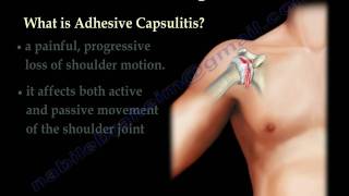 Adhesive Capsulitis frozen shoulder  Everything You Need To Know  Dr Nabil Ebraheim [upl. by Jeremiah]