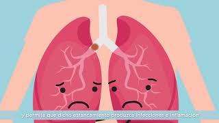 Vídeo 1  ¿Qué es la Fibrosis Quística [upl. by Lucia]