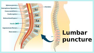 lumbar puncture [upl. by Yaya562]