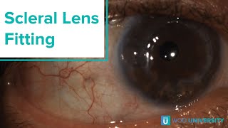 Scleral Lens Fitting Compression and Impingement [upl. by Medeah]