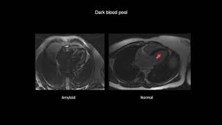 How to assess cardiac amyloidosis with CMR cardiac magnetic resonance imaging [upl. by Nolie]