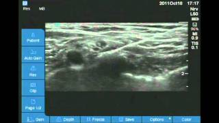 Ultrasound Guided Supraclavicular block [upl. by Mcgee]