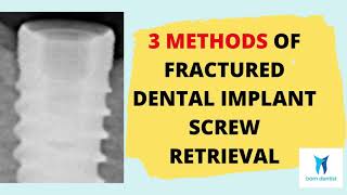 3 methods for broken screw removal in implantology [upl. by Christyna585]