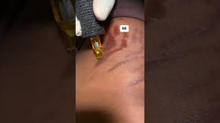 Stretch mark removal in South Africa Stretch mark removal at home [upl. by Haig]