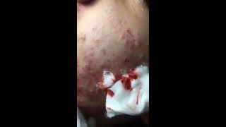 Impefections extraction 6 Gross bloody cheek acne extraction [upl. by Ardnuassak]