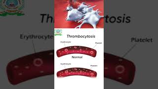 Thrombocytopenia  Thrombocytosis  Their symptoms  Treatment [upl. by Willin]