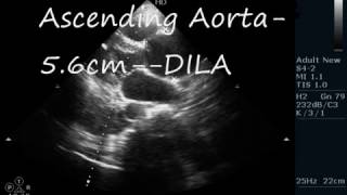 DISSECTION OF AORTA  ECHOCARDIOGRAPHY SERIES BY DR ANKUR K CHAUDHARI [upl. by Aniryt]