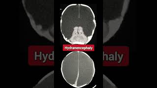 Hydranencephaly  Radiology [upl. by Kalin]