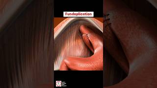 Fundoplication  Surgical Procedure [upl. by Blinny]