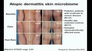 Eczema Immunity and the Skin Microbiome  Heidi Kong [upl. by Masao486]