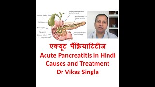 Acute Pancreatitis Treatment and Causes in Hindi By Dr Vikas Singla Max Hospital New Delhi [upl. by Bixby363]