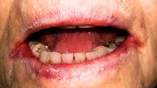 What is Angular Cheilitis Symptoms Causes Treatment [upl. by Isacco]