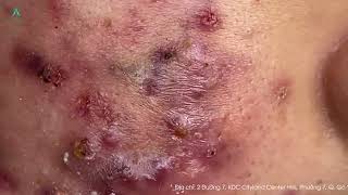 Big Cystic Acne Blackheads Extraction Blackheads amp Milia Whiteheads Removal Pimple Popping [upl. by Ratcliff]