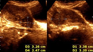 Three cases of Leiomyoma Uterus  Abnormal Uterine Bleeding  sonographic prediction [upl. by Wera]