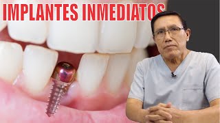 IMPLANTE DENTAL INMEDIATO 🦷 En una SESIÓN 👄 reemplazo dental en 1 🦷 Dr YURI MARTINEZ 💋 Prodent Perú [upl. by Ziegler86]