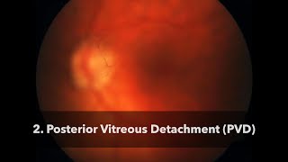 2 Posterior Vitreous Detachment PVD [upl. by Zahc]