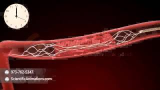 Mechanical Thrombectomy  Neurovascular stent deployment [upl. by Guss117]