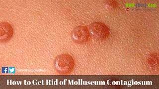 What To Know About Molluscum Contagiosum [upl. by Agan]