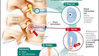 Hernie discale lombaire symptômes diagnostic [upl. by Eyatnod]